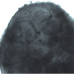 Cherry_Biotech_kidney_biopsy_2