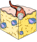 Adiponecting Type 2 Diabetes